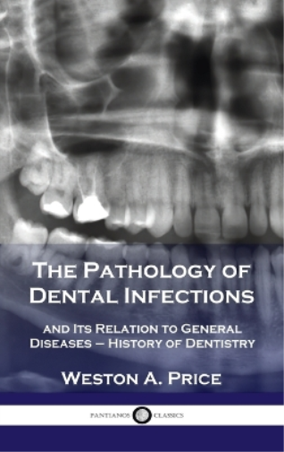 Pathology of Dental Infections