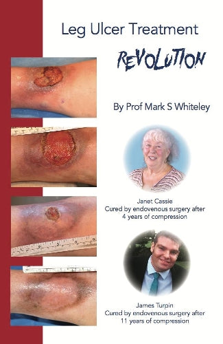 Leg Ulcer Treatment Revolution