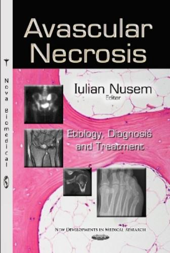 Avascular Necrosis