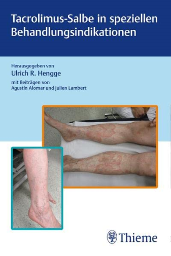 Tacrolimus-Salbe in speziellen Behandlungsindikati