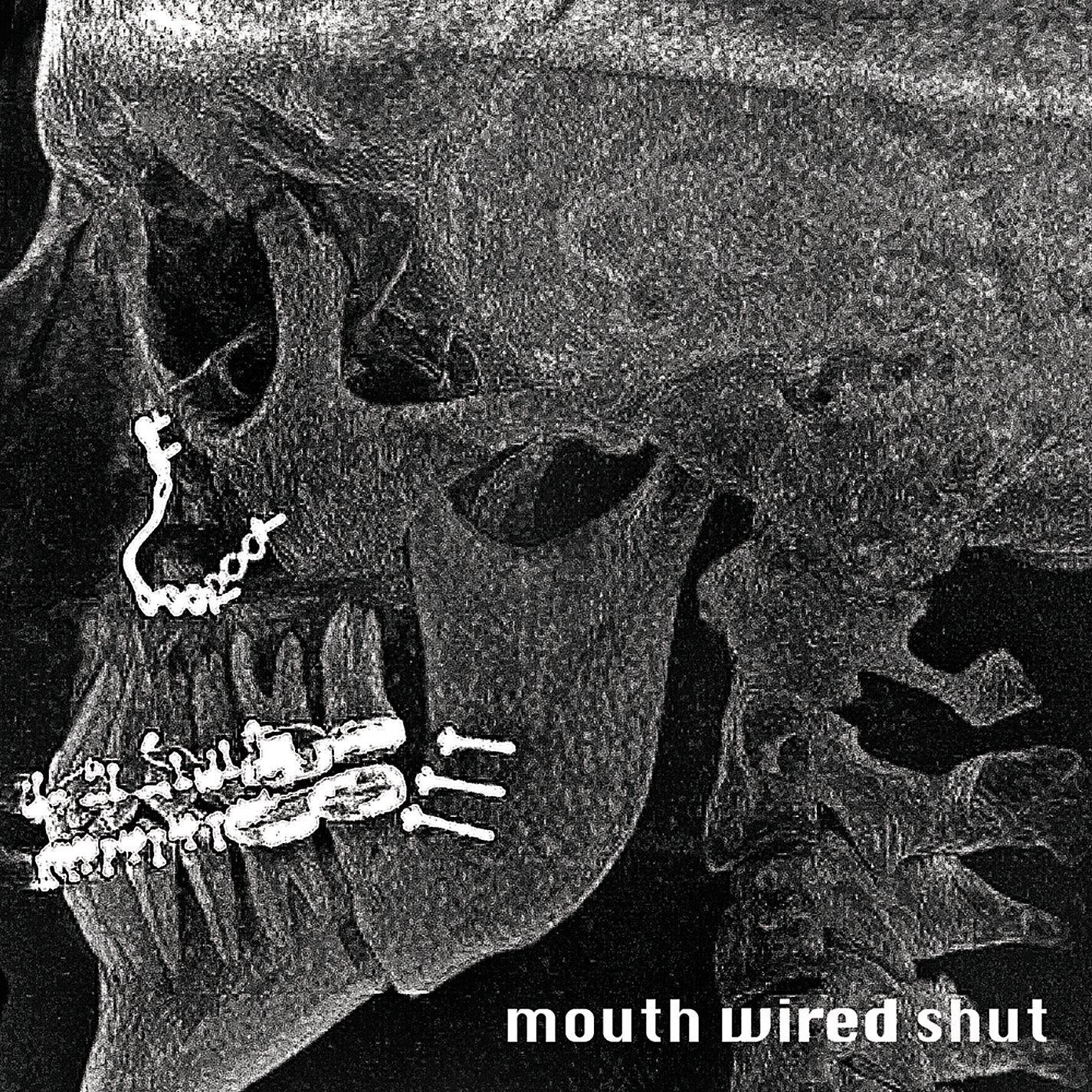 Mouth Wired Shut