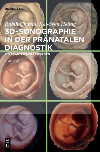 3d-Sonographie in Der Pränatalen Diagnostik