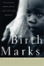 Birthmarks