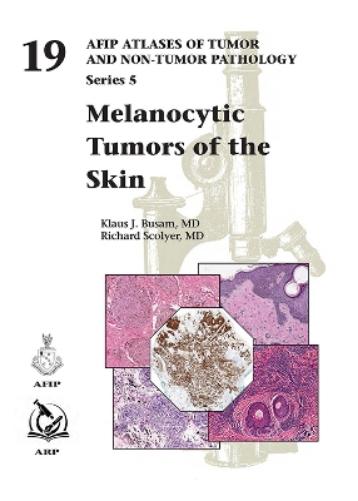 Melanocytic Tumors of the Skin