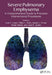 Severe Pulmonary Emphysema: