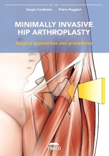 Minimally Invasive Hip Arthroplasty